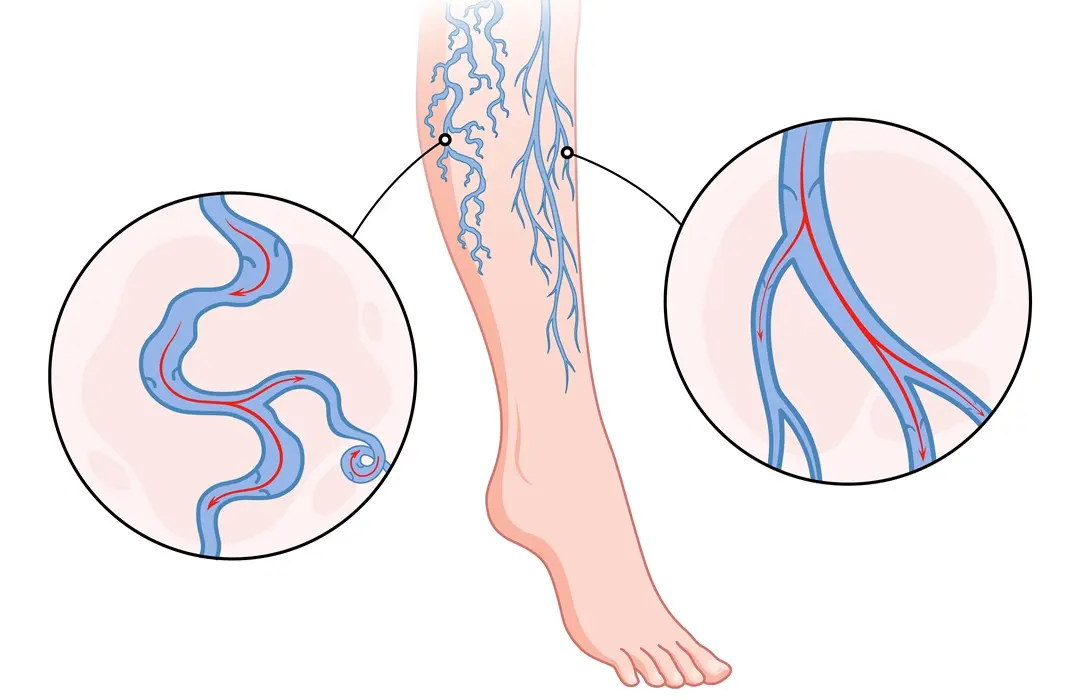 1078Z_Varicose-01 Seprűvénából visszér? Így előzd meg Sejtvédelem 