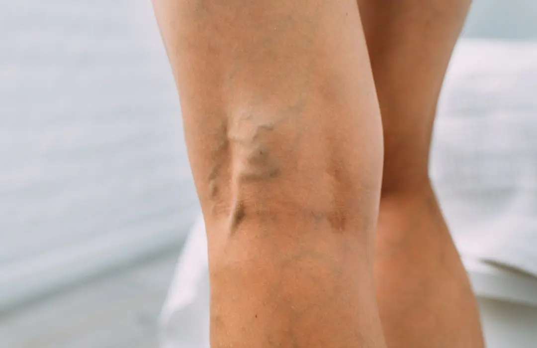 5879 Seprűvénából visszér? Így előzd meg Sejtvédelem 