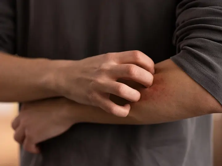 C3A9telallergia-viszketes-borpir Ételallergiák: Hogyan támogathatod magad? Immunrendszer 