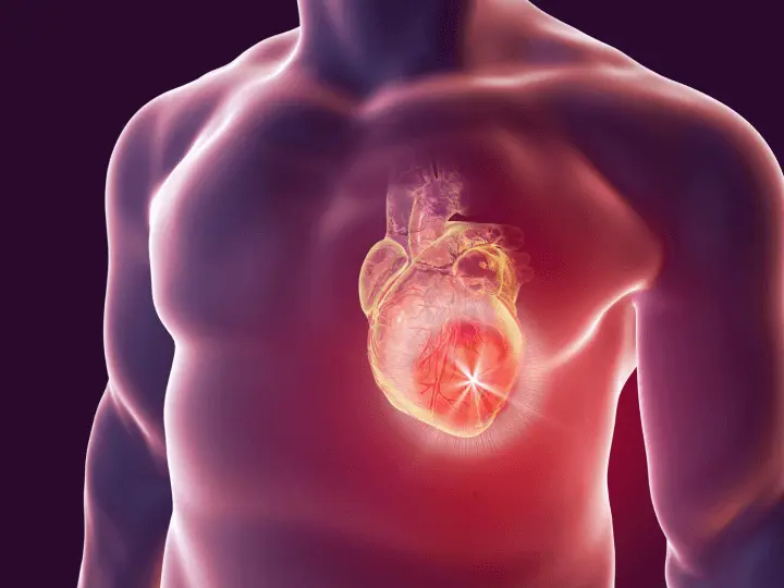 angina-pectoris-rizikofaktorok Mi az Angina pectoris? Immunrendszer 