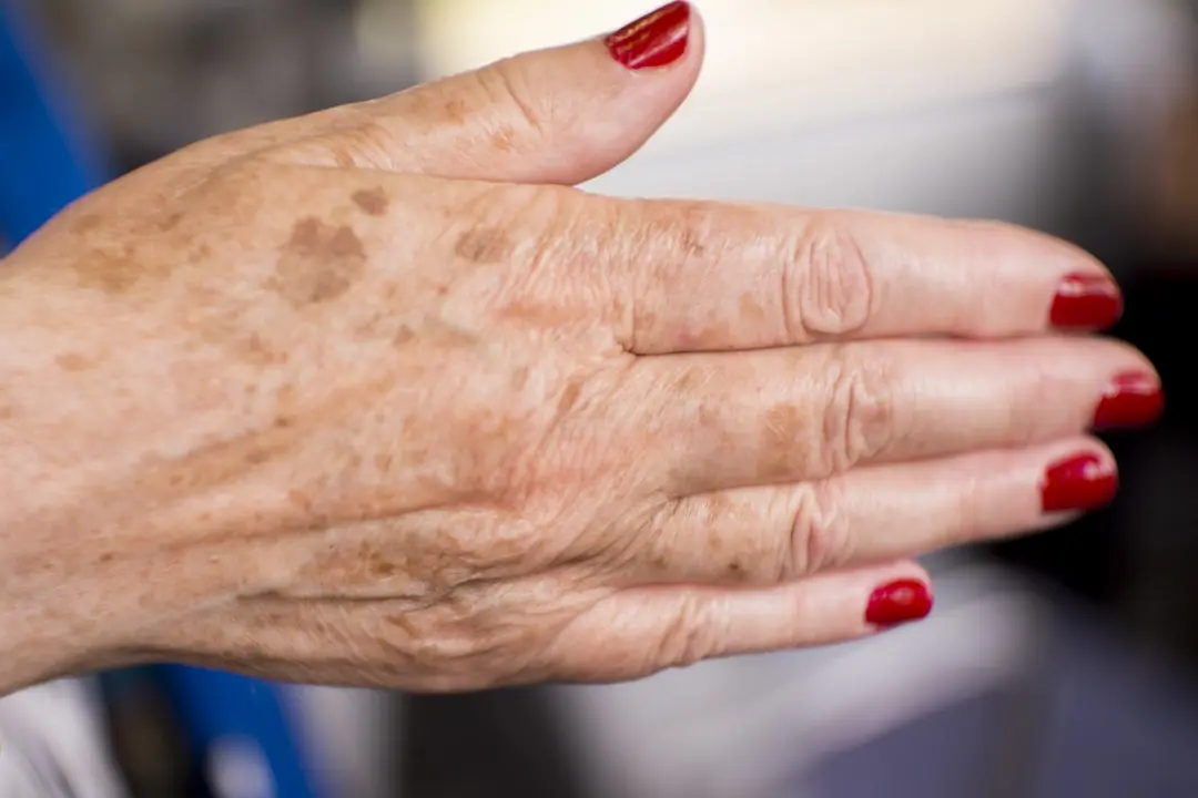 close-up-hand-with-maroon-nail-polish Öregségi foltok: Mit tehetünk ellene? Sejtvédelem 