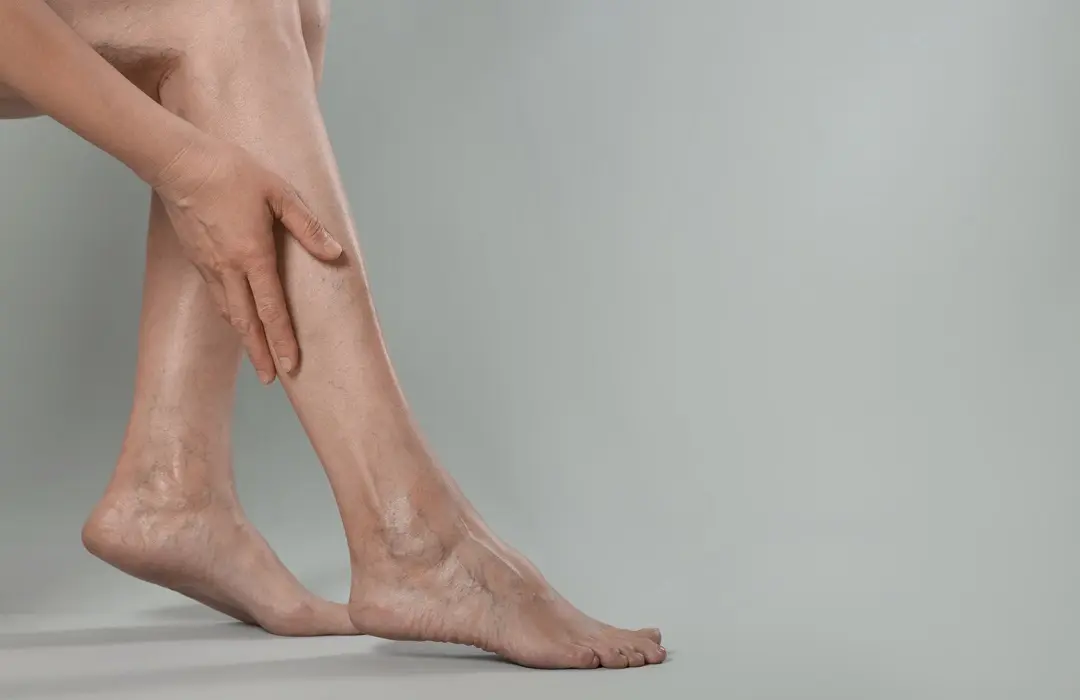 closeup-view-woman-suffering-from-varicose-veins-light-grey-background-space-text Megelőzhetők a visszér szövődményei? Hogyan? Sejtvédelem 