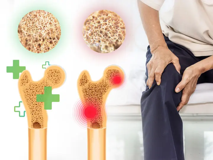 csontritkulas-mit-jelent A csontritkulás javítható, itt van 4 tápanyag hozzá! Immunrendszer 