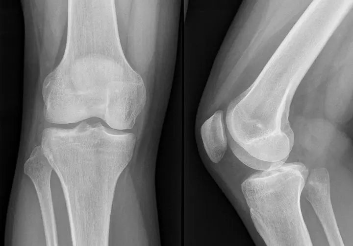 erosebb-csontok-kollagen-por A sportolók fehérjéje, a kollagén Immunrendszer 