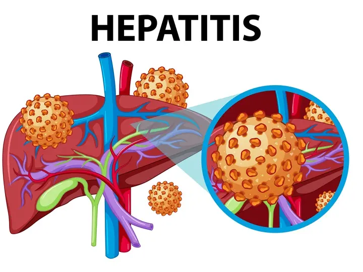 hepa Hepatitis fertőzés – Hogyan előzd meg? Emésztés 