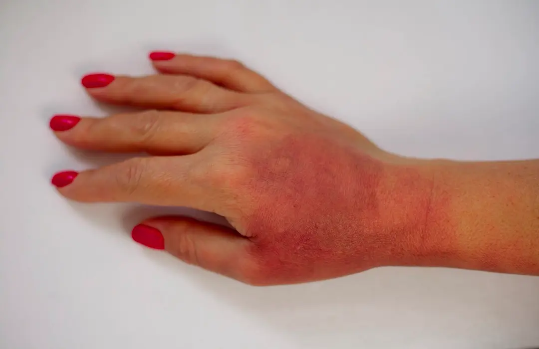 horrible-burns-female-hand-isolated-white Krónikus gyulladás?Természetes megoldások! Sejtvédelem 