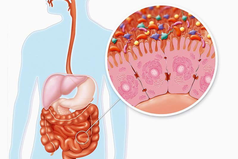 irritabilis-belszindroma-ibs Amit mindig is tudni akartál az IBS-ről és a SIBO-ról! Emésztés 