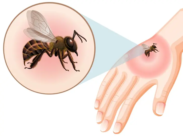 jon5_bd6l_220912 Méh- és darázscsípés – A legfontosabb teendők Immunrendszer 
