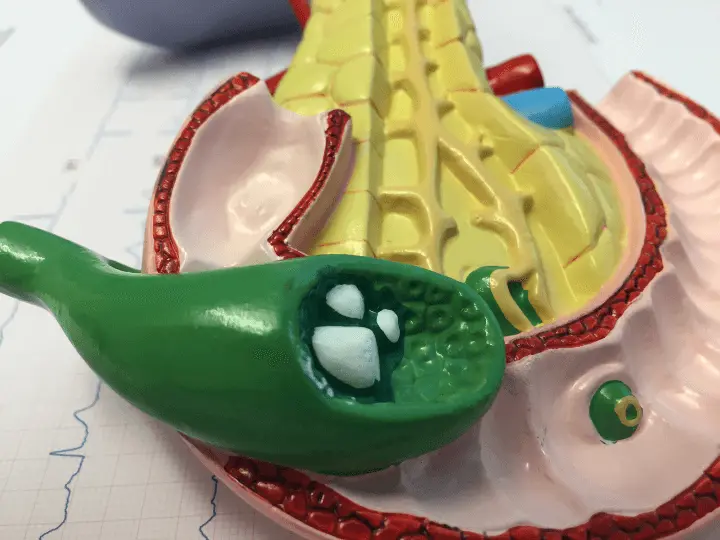 mikor-kell-eltavolitani-az-epeholyagot Élet az epehólyageltávolító műtét után Emésztés 