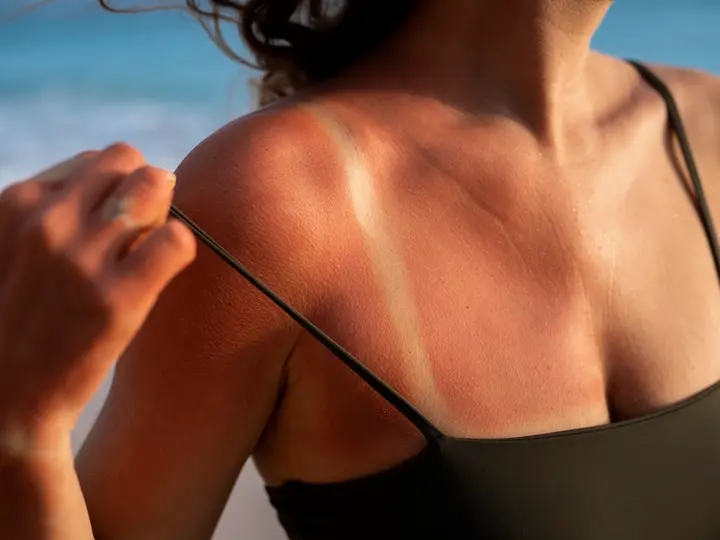 naperz3_1 Napérzékenység? Napvitaminnal védd a bőröd! Sejtvédelem 