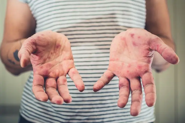 ovsomor-kezelese-hazilag Övsömör kezelése házilag Immunrendszer 