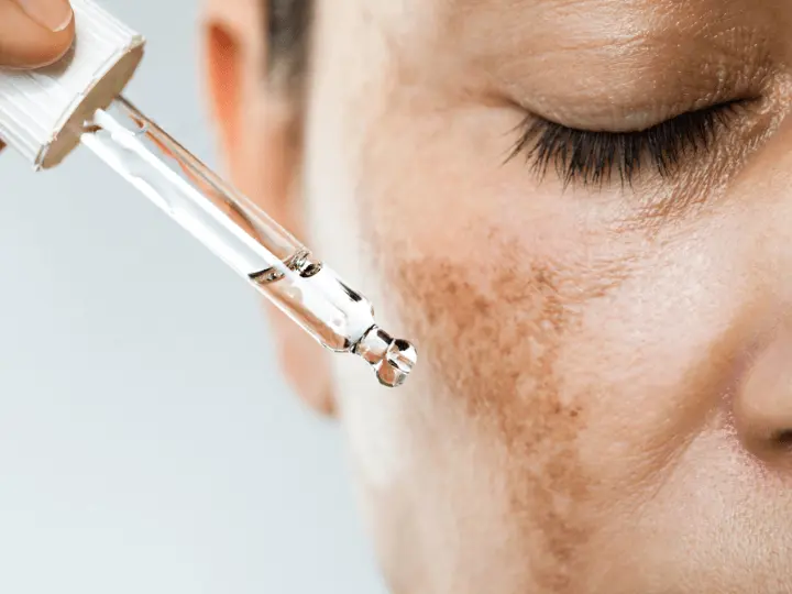 pigmentfolt-majfolt-halvanyitasa Természetes megoldások májfolt, pigmentfolt ellen Szépség 