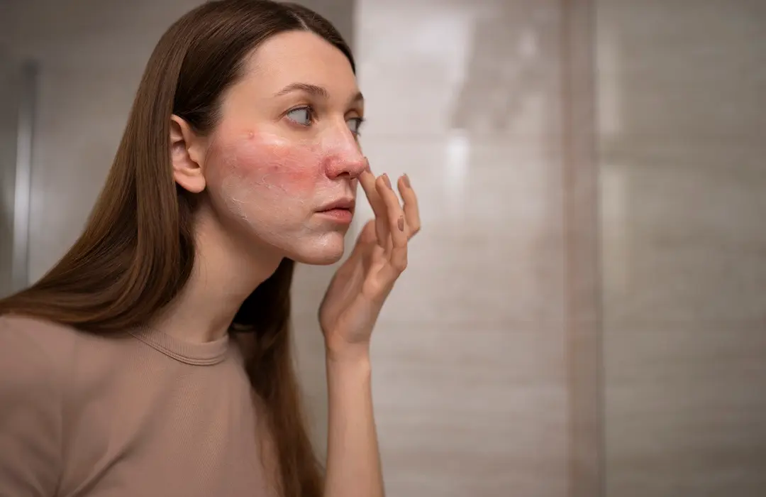 woman-looking-her-rosacea-mirror Krónikus gyulladás?Természetes megoldások! Sejtvédelem 