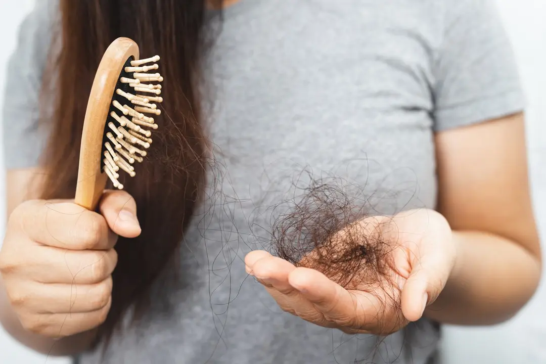 women-with-hair-loss Szezonális hajhullás: mit tehetsz ellene? Szépség 