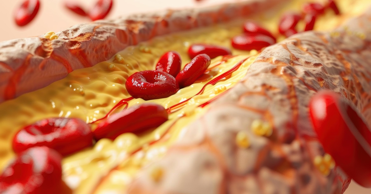 magas-triglicerid-laborertek Magas triglicerid: mit jelent és mit tehetsz ellene? Sejtvédelem 